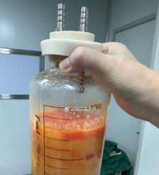 滦南水动力吸脂手术要做多久？